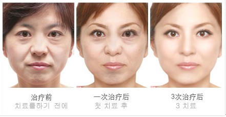PRP除皱美容